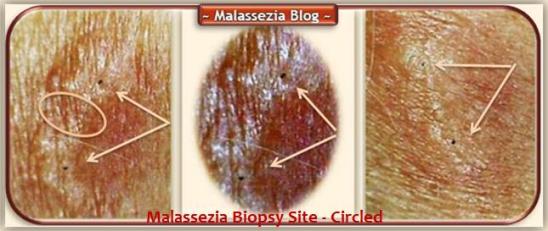 Biopsy Site 1 MB
