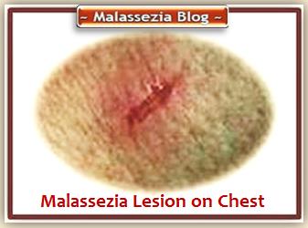 Malassezia Lesion 2 MB
