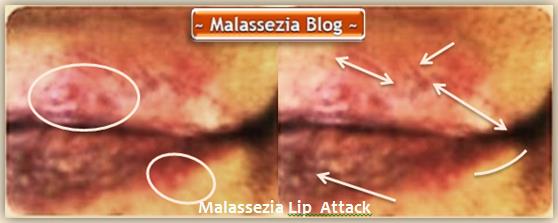 Malassezia Lip Attack1 MB