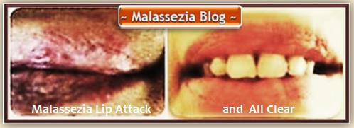 Malassezia Lip Attack2 MB