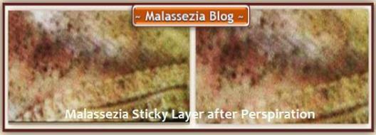 Malassezia  Sticky Layer-Perspiration2 MB