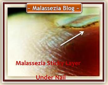 Malassezia Under Nails3 MB