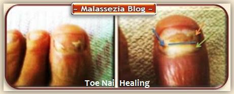 Toe Nail Healing 1 MB