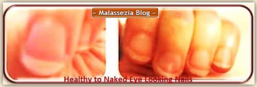 Malassezia and Nails3 MB