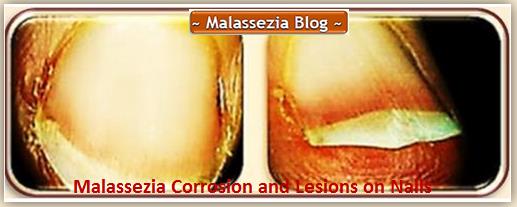 Malassezia and Nails4 MB