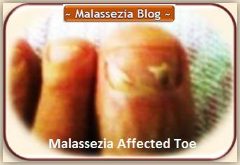 Malassezia and Toe1 MB