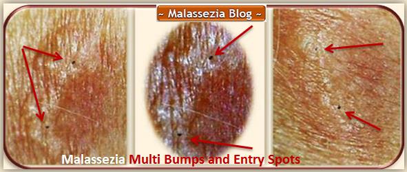 Malassezia  Bumps 2 MB