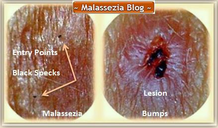 Malassezia  Bumps1 MB