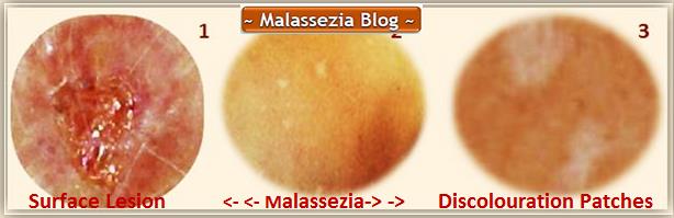 Malassezia Discolouration Patches1 MB