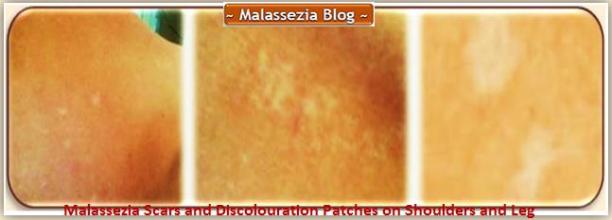 Malassezia Discolouration Patches2 MB