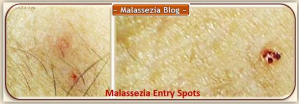 Malassezia Entry Specks1 MB