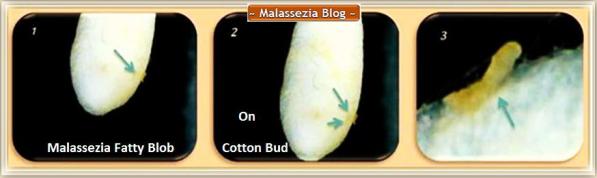 Malassezia Fatty Blob on Cotton Bud1 MB