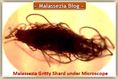 Malassezia  Gritty Shard under Microscope1 MB