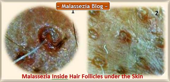 Malassezia Hair Follicles2 MB