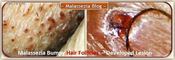 Malassezia Hair Follicles3 MB