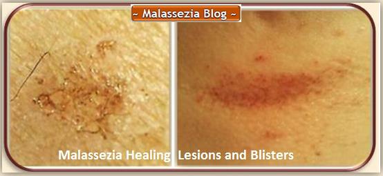 Malassezia Healing Lesion and Blisters1 MB