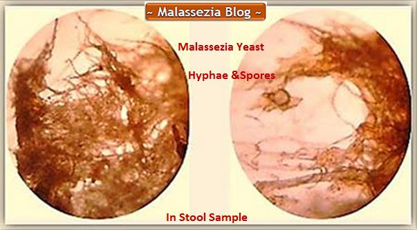 Malassezia Hyphae and Spores -Stool1 MB
