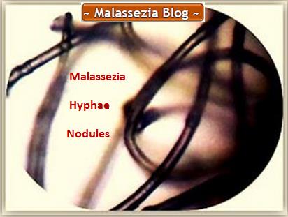 Malassezia  Hyphae Nodules1 MB