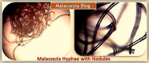 Malassezia  Hyphae with Nodules1 MB