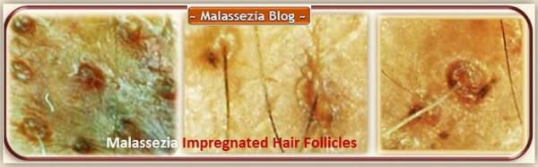 Malassezia impregnated Hair Follicles2 MB