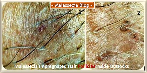 Malassezia imprgnated Hair Follicles1 MB