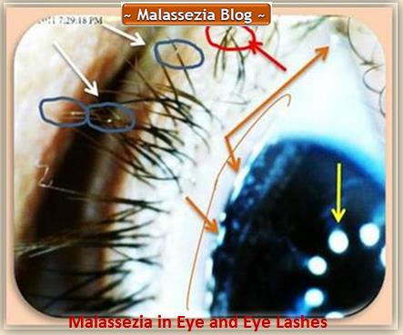 Malassezia  In Eye and Eye Lashes1 MB