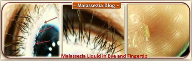 Malassezia  In Eye and Fingertip2 MB