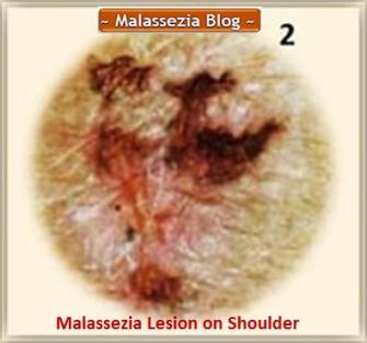 Malassezia  Lesion on shoulder1 MB