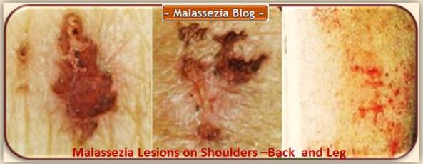 Malassezia  Lesion on shoulder2 MB