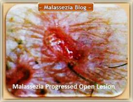 Malassezia  Lesion1 MB