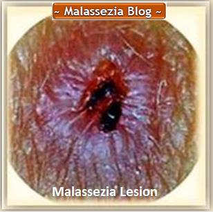 Malassezia  Lesion2 MB