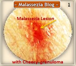 Malassezia  Lesion3 MB