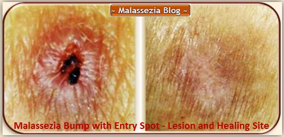 Malassezia  Lesion4 MB