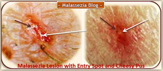 Malassezia  Lesion5 MB
