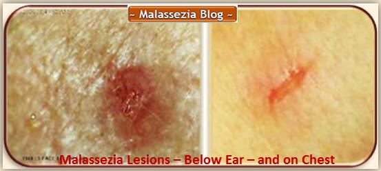 Malassezia  Lesions Ear-Chest6 MB