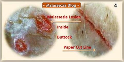 Malassezia  Lesions on buttocks1 MB