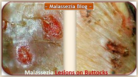 Malassezia  Lesions on Buttocks2 MB