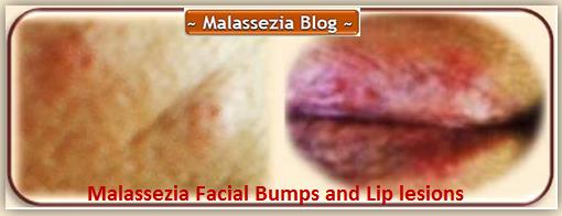 Malassezia on Face and Lips1 MB