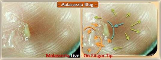 Malassezia on Fingers1