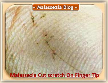 Malassezia on Fingers2