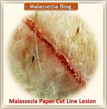 Malassezia  Paper Cut  Lesion1 MB