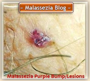 Malassezia Purple Bumps -Lesions1 MB