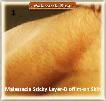 Malassezia Sticky Layer on Skin1 MB