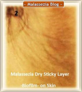 Malassezia Sticky Layer on Skin2 MB