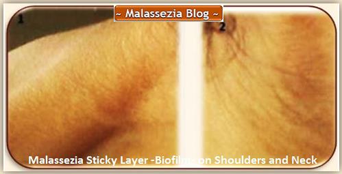 Malassezia Sticky Layer on Skin4 MB