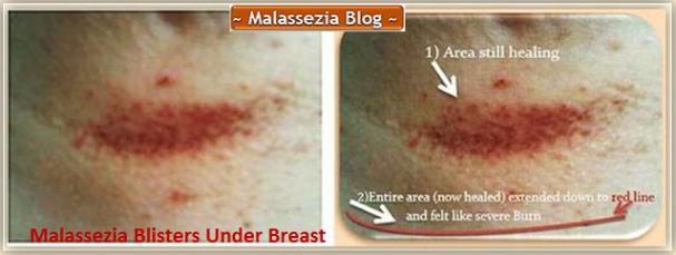 Malassezia  Under Breast1 MB