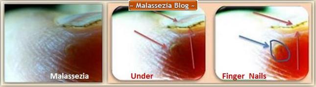 Malassezia Under Nails1 MB