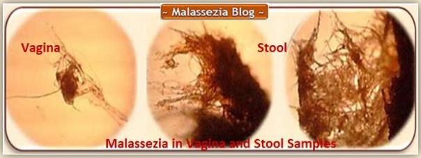 Malassezia - Vagina and Stools1 MB