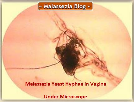 Malassezia Yeast in Vagina1 MB