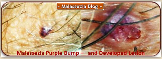 Purple Bump and developed Lesion2 MB